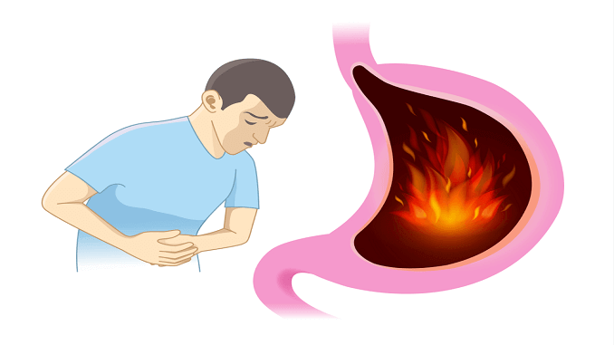 10 signs of gastroesophageal reflux disease