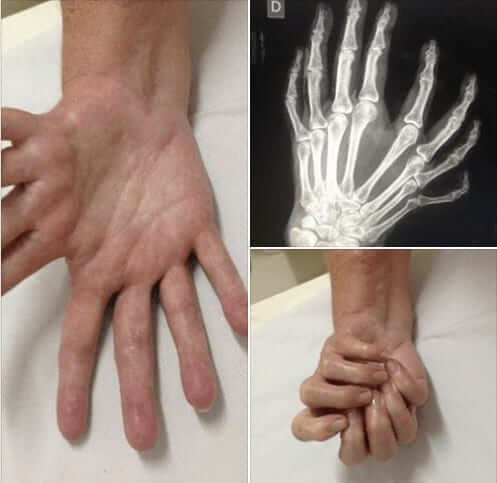 Have you heard on the ulnar dimelia or mirror hand ...