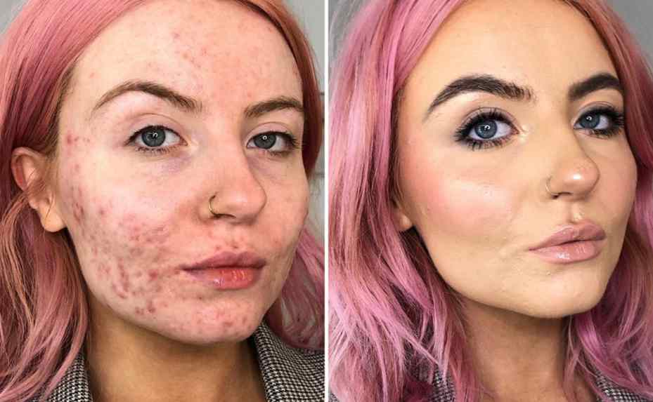 acne before and after makeup