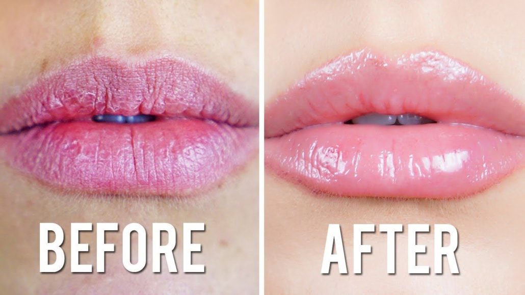 3 Natural Methods Save Chapped Lips - Tips for Caring for Winter Lips