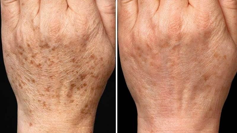 laser treatments for age spots