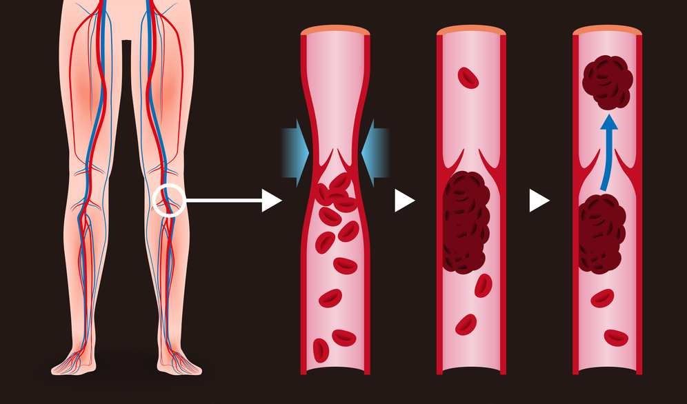 blood clot in brain surgery recovery