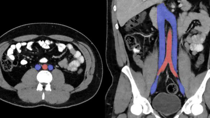 ivc blood clot filter What You Should Know