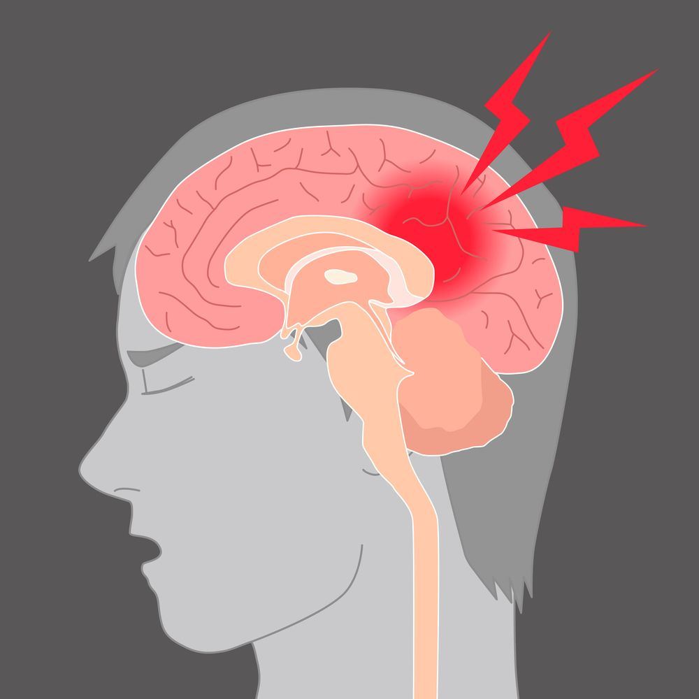 
what is stroke symptoms
