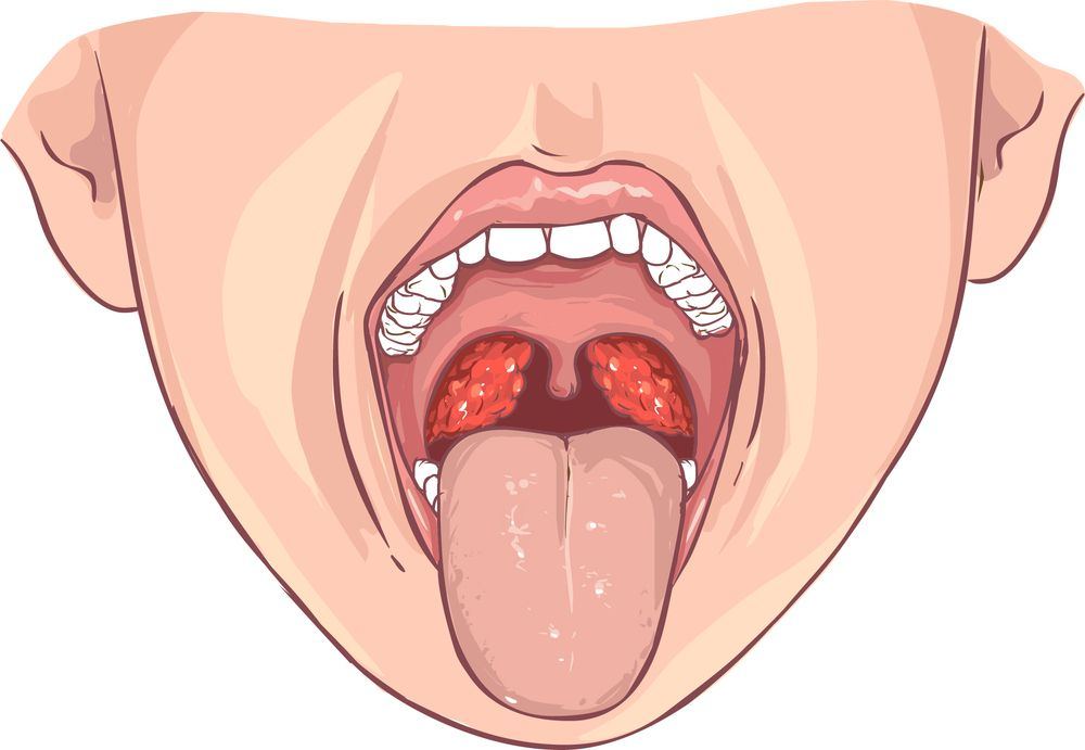 What Do Doctors Give For Sore Throat